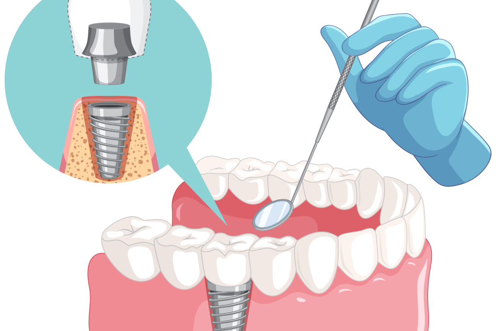 Extracao especialidade